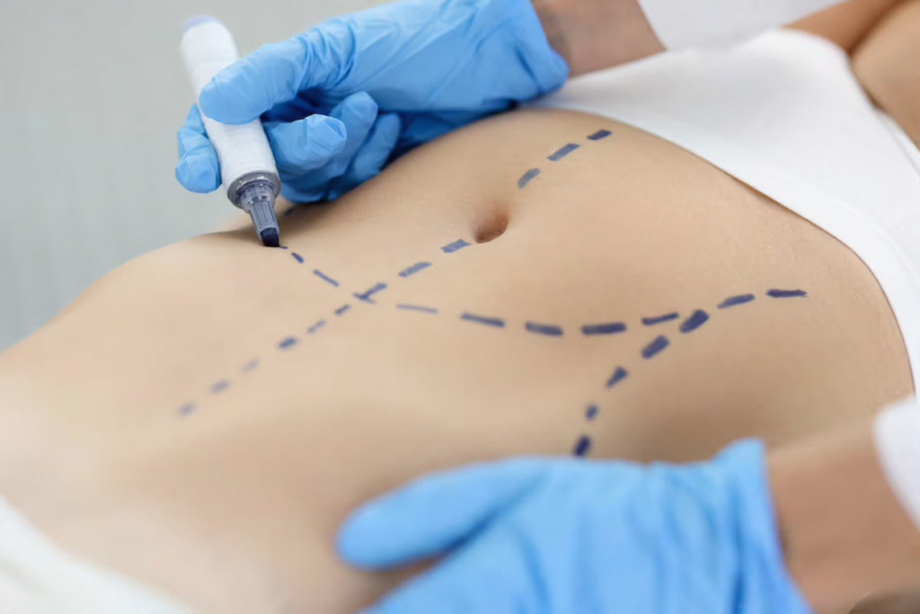 Non Surgical Liposuction