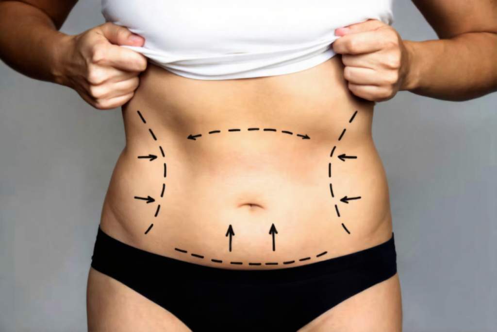 Non Surgical Liposuction