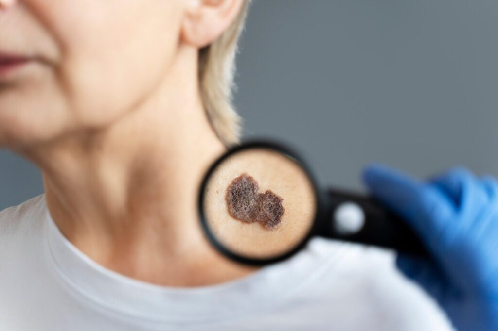 Mole Removal Treatment