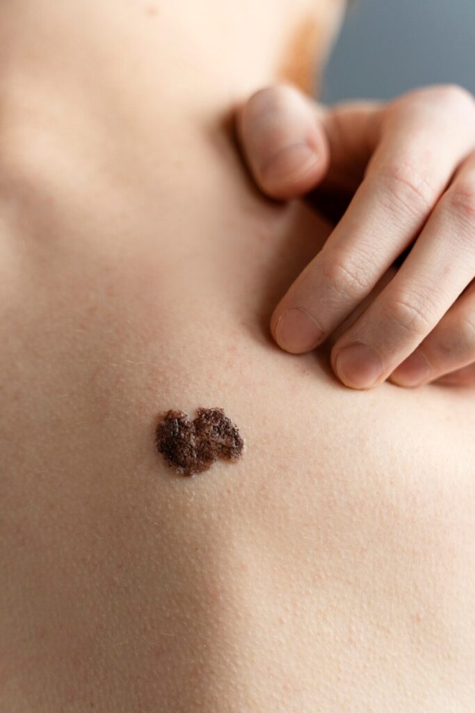 Mole Removal Treatment