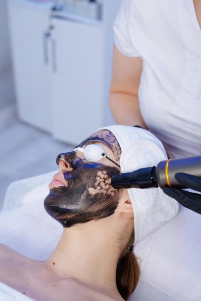 Carbon Laser Treatment