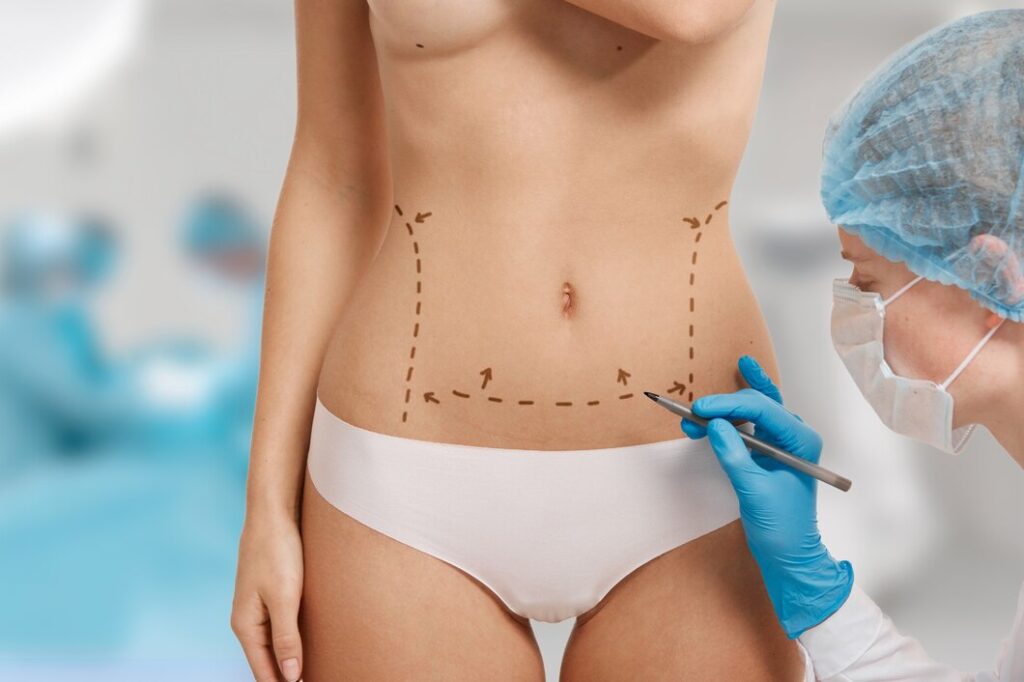 Non Surgical Liposuction