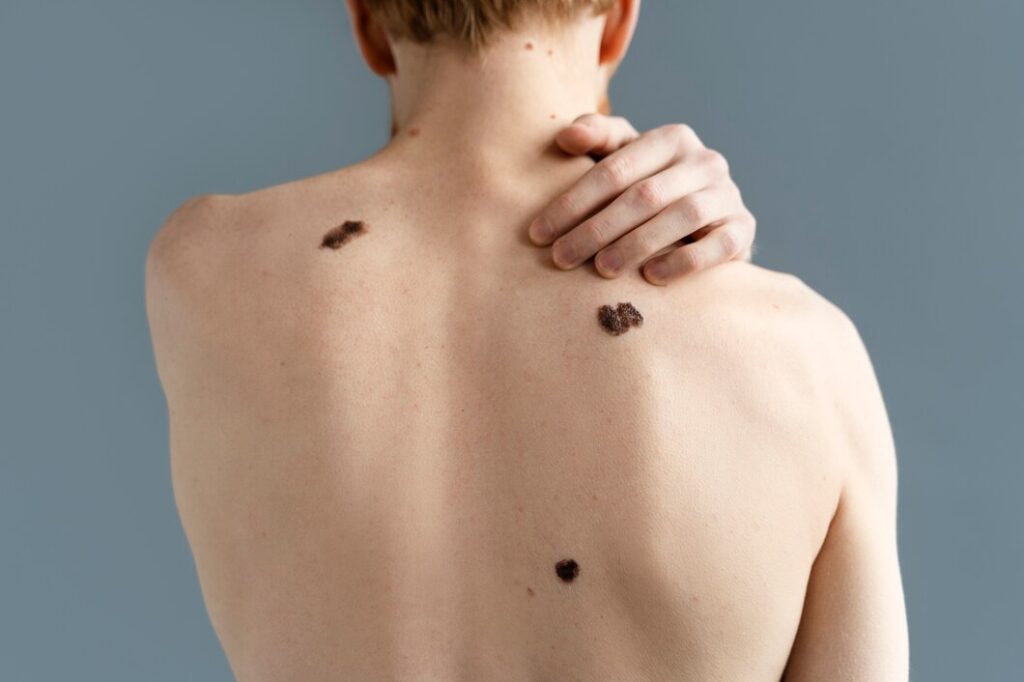 Mole Removal Treatment