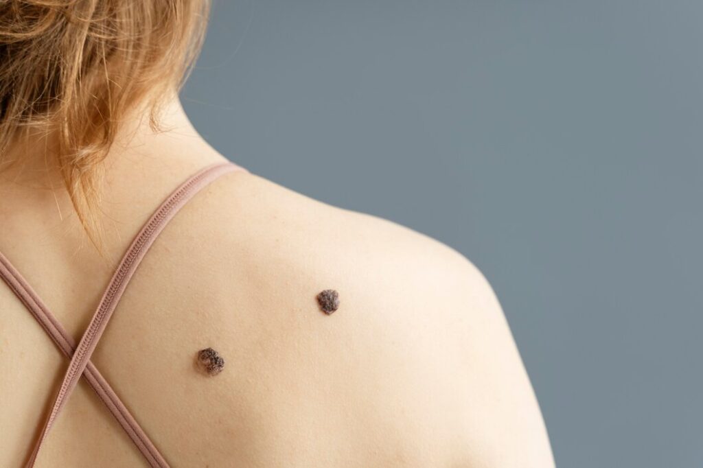 Mole Removal Treatment