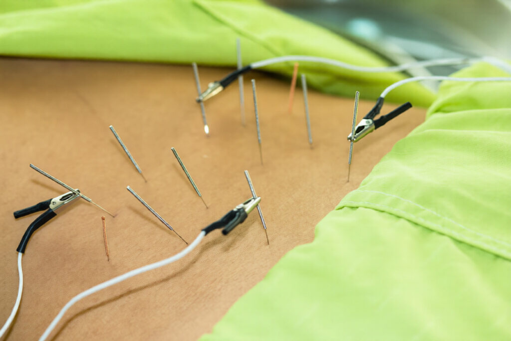 Dry Needling Physiotherapy